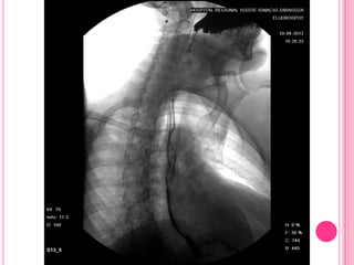 Serie esofagogastroduodenal