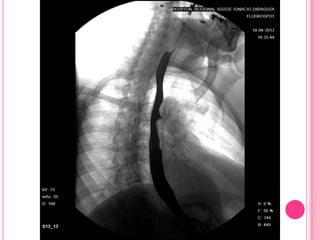 Serie esofagogastroduodenal