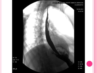 Serie esofagogastroduodenal