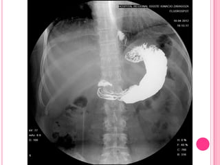 Serie esofagogastroduodenal