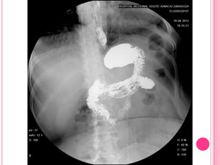Serie esofagogastroduodenal
