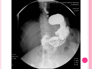 Serie esofagogastroduodenal
