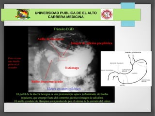 UNIVERSIDAD PUBLICA DE EL ALTO
CARRERA MEDICINA
ULCERA GÁSTRICA
 