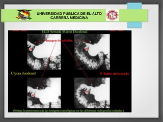 UNIVERSIDAD PUBLICA DE EL ALTO
CARRERA MEDICINA
ULCERA GÁSTRICA
 