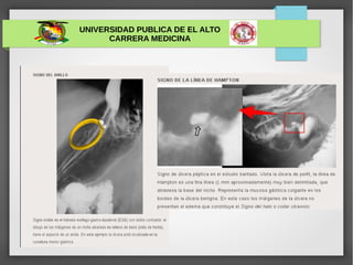 UNIVERSIDAD PUBLICA DE EL ALTO
CARRERA MEDICINA
ULCERA GÁSTRICA
 