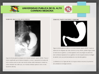 UNIVERSIDAD PUBLICA DE EL ALTO
CARRERA MEDICINA
ULCERA GÁSTRICA
 