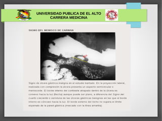 UNIVERSIDAD PUBLICA DE EL ALTO
CARRERA MEDICINA
ULCERA GÁSTRICA
 