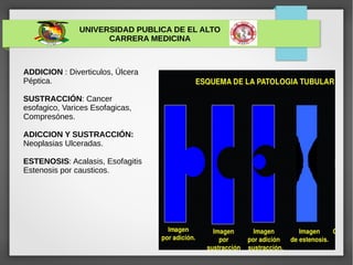 UNIVERSIDAD PUBLICA DE EL ALTO
CARRERA MEDICINA
ADDICION : Diverticulos, Úlcera
Péptica.
SUSTRACCIÓN: Cancer
esofagico, Varices Esofagicas,
Compresónes.
ADICCION Y SUSTRACCIÓN:
Neoplasias Ulceradas.
ESTENOSIS: Acalasis, Esofagitis
Estenosis por causticos.
 