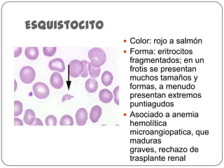 EsquistocitoColor: rojo a salmónForma: eritrocitos fragmentados; en un frotis se presentan muchos tamaños y formas, a menudo presentan extremos puntiagudosAsociado a anemia hemolítica microangiopatica, quemaduras graves, rechazo de trasplante renal