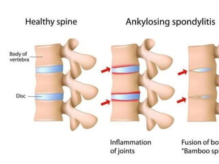 • “ Bamboo spine”
Thin and slender syndesmophytes are generally
evident, representing ossification of the outer layer
of the annulus fibrosis.
On AP lumbar spine radiographs the
syndesmophytes thicken,become continuous giving
knobbly appearance.
 
