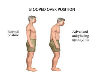 STOOPED OVER POSITION
 