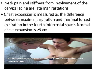 • Neck pain and stiffness from involvement of the
cervical spine are late manifestations.
• Chest expansion is measured as the difference
between maximal inspiration and maximal forced
expiration in the fourth intercostal space. Normal
chest expansion is ≥5 cm
 