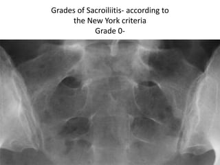 Grades of Sacroiliitis- according to
the New York criteria
Grade 0-
 