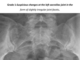 Grade 1-Suspicious changes at the left sacroiliac joint in the
form of slightly irregular joint facets.
 