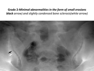 Grade 2-Minimal abnormalities in the form of small erosions
black arrow) and slightly condensed bone sclerosis(white arrow)
 
