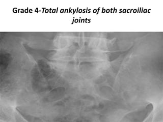 Grade 4-Total ankylosis of both sacroiliac
joints
 