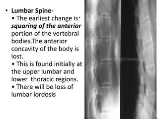.
• Lumbar Spine-
• The earliest change is
squaring of the anterior
portion of the vertebral
bodies.The anterior
concavity of the body is
lost.
• This is found initially at
the upper lumbar and
lower thoracic regions.
• There will be loss of
lumbar lordosis
 