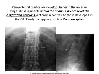 Paravertebral ossification develops beneath the anterior
longitudinal ligaments within the annulus at each level.The
ossification develops vertically in contrast to those developed in
the OA. Finally the appearance is of Bamboo spine.
 