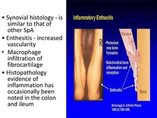 • Synovial histology - is
similar to that of
other SpA
• Enthesitis - increased
vascularity
• Macrophage
infiltration of
fibrocartilage
• Histopathology
evidence of
inflammation has
occasionally been
noted in the colon
and ileum
 