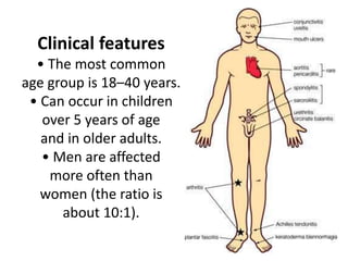 Clinical features
• The most common
age group is 18–40 years.
• Can occur in children
over 5 years of age
and in older adults.
• Men are affected
more often than
women (the ratio is
about 10:1).
 