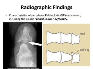 Radiographic Findings
• Characteristics of peripheral PsA include DIP involvement,
including the classic "pencil-in-cup" deformity.
 
