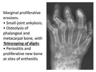 Marginal proliferative
erosions.
• Small-joint ankylosis.
• Osteolysis of
phalangeal and
metacarpal bone, with
Telescoping of digits.
• Periostitis and
proliferative new bone
at sites of enthesitis
 