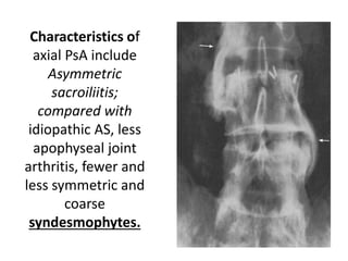 Characteristics of
axial PsA include
Asymmetric
sacroiliitis;
compared with
idiopathic AS, less
apophyseal joint
arthritis, fewer and
less symmetric and
coarse
syndesmophytes.
 