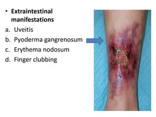 • Extraintestinal
manifestations
a. Uveitis
b. Pyoderma gangrenosum
c. Erythema nodosum
d. Finger clubbing
 