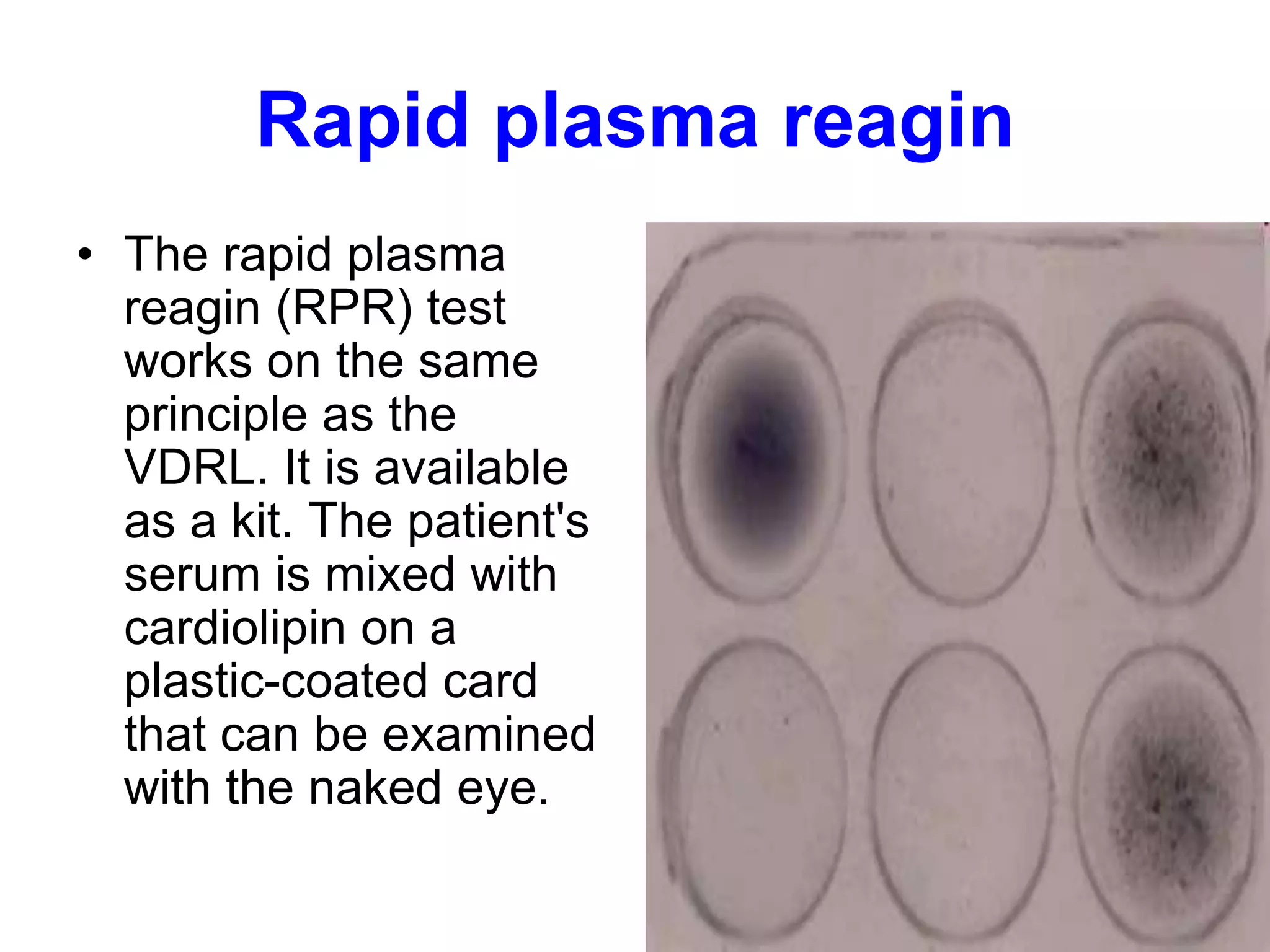 Rapid plasma reagin
• The rapid plasma
reagin (RPR) test
works on the same
principle as the
VDRL. It is available
as a kit. The patient's
serum is mixed with
cardiolipin on a
plastic-coated card
that can be examined
with the naked eye.
 