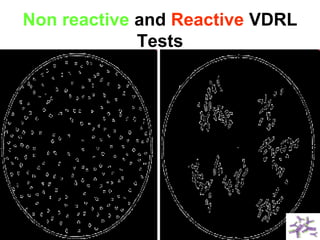 Non reactive and Reactive VDRL
Tests
 