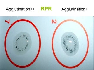 Agglutination++ RPR Agglutination+
 