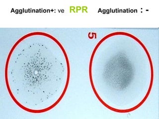 Agglutination+: ve RPR Agglutination : -
 