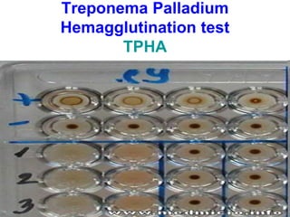 Treponema Palladium
Hemagglutination test
TPHA
 