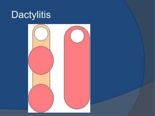 Dactylitis
 