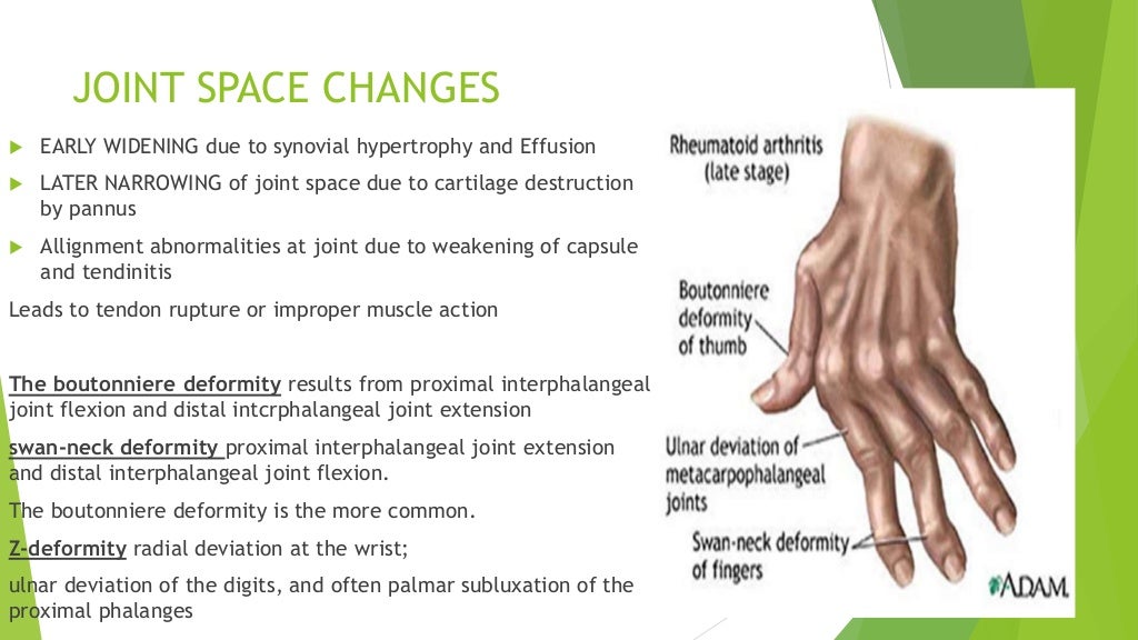 Seropositive arthritis Rheumatoid and others