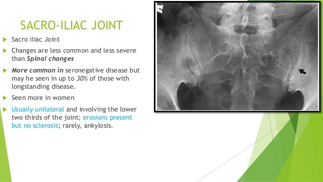 Seropositive arthritis Rheumatoid and others