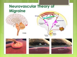 Neurovascular Theory of
Migraine
 