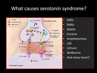 What causes serotonin syndrome?
• SSRIs
• SNRIs
• MAOIs
• Cocaine
• Amphetamines
• LSD
• Lithium
• Wellbutrin
• And many more!!
 