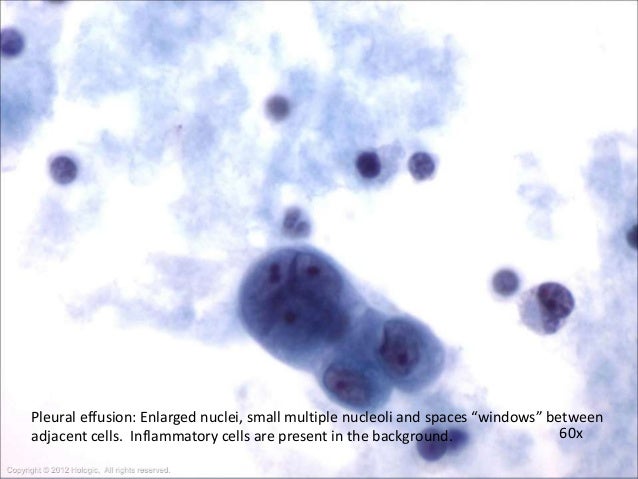 Fluid cytology in serous cavity effusions