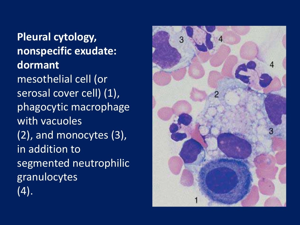 Fluid cytology in serous cavity effusions