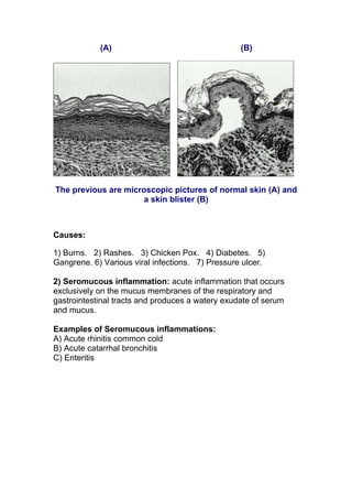 (A)                                   (B)




The previous are microscopic pictures of normal skin (A) and
                     a skin blister (B)



Causes:

1) Burns. 2) Rashes. 3) Chicken Pox. 4) Diabetes. 5)
Gangrene. 6) Various viral infections. 7) Pressure ulcer.

2) Seromucous inflammation: acute inflammation that occurs
exclusively on the mucus membranes of the respiratory and
gastrointestinal tracts and produces a watery exudate of serum
and mucus.

Examples of Seromucous inflammations:
A) Acute rhinitis common cold
B) Acute catarrhal bronchitis
C) Enteritis
 