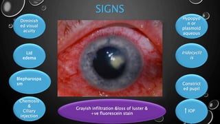SIGNS
Diminish
ed visual
acuity
Lid
edema
Constrict
ed pupil
Iridocyclit
is
Hypopyo
n or
plasmoid
aqueous
Chemosis
&
Ciliary
injection
Blepharospa
sm
IOP
Grayish infiltration &loss of luster &
+ve fluorescein stain
 