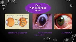 Early
Non perforated
ulcer
Secondary glaucoma descemetocele secondary
iridocyclitis
 