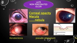 LATE
NON PERFORATED
ULCER
Corneal opacity
Macula
……nebula
Keratectesia pseudo pterygium fac
 