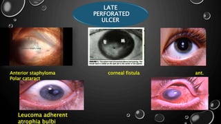 LATE
PERFORATED
ULCER
Anterior staphyloma corneal fistula ant.
Polar cataract
Leucoma adherent
atrophia bulbi
 