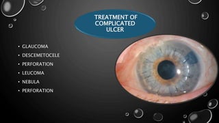 • GLAUCOMA
• DESCEMETOCELE
• PERFORATION
• LEUCOMA
• NEBULA
• PERFORATION
TREATMENT OF
COMPLICATED
ULCER
 
