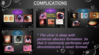 COMPLICATIONS
* The ulcer is deep with
posterior abscess formation. So
that it commonly perforates and
descemetocele is never formed.
 