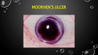 MOORHEN’S ULCER
 