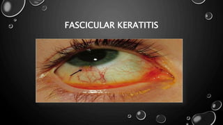 FASCICULAR KERATITIS
 