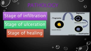 PATHOLOGY
Stage of infiltration
Stage of ulceration
Stage of healing
 